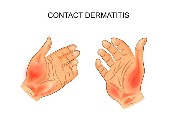 Контактный дерматит, дерматология — стоковый вектор
