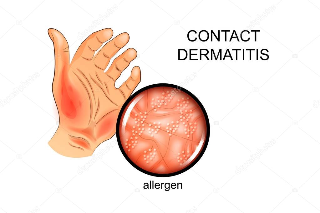 allergen on the skin. Allergy, dermatology