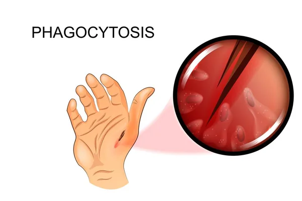 Dolore alla mano. fagocitosi — Vettoriale Stock