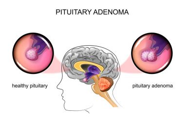 bir sağlıklı hipofiz ve hipofiz adenom