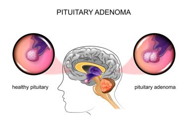 a healthy pituitary and pituitary adenoma clipart