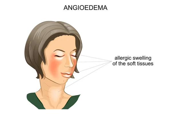 Angioedema. allergic swelling — Stock Vector