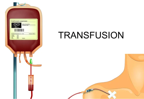 Transfusion of donor blood to the patient through the subclavian — Stock Vector