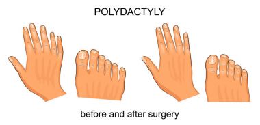polydactyly öncesi ve ameliyat sonrası