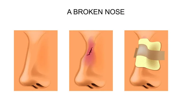 A broken nose — Stock Vector