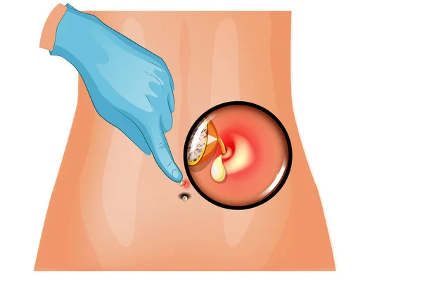 Supuración del piercing del ombligo — Archivo Imágenes Vectoriales