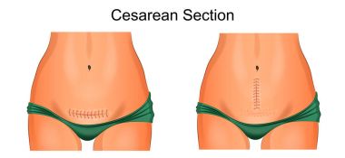 cesarean bölüm sonra dikiş