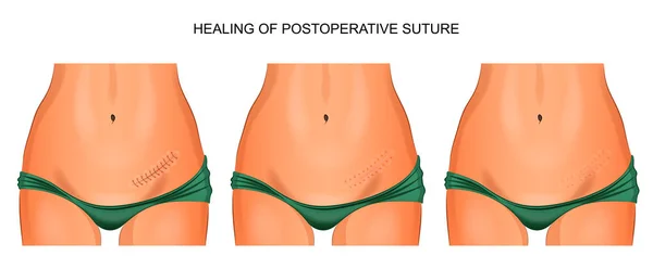 O abdómen feminino. articulação cicatrizante após apendicectomia —  Vetores de Stock