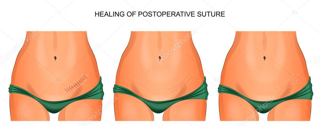 the female abdomen. healing joint after appendectomy