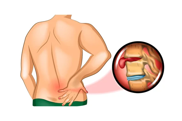 Back pain. damage to the spine — Stock Illustration Back pain. damage to the spine Stock Illustration