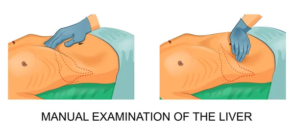 Examen manuel du foie — Image vectorielle