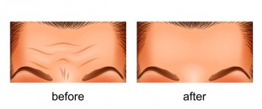 skin rejuvenation forehead. before and after clipart