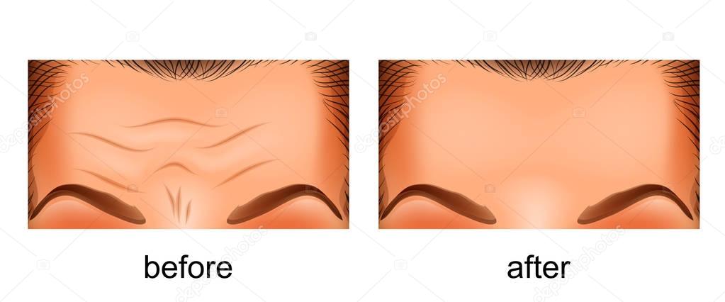 skin rejuvenation forehead. before and after