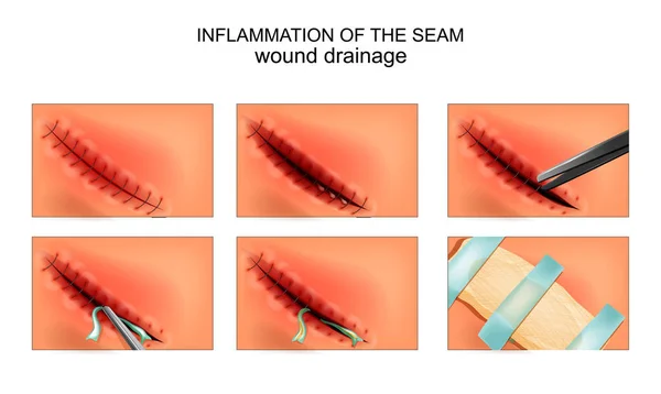 Inflamación del sitio quirúrgico. drenaje de la herida — Archivo Imágenes Vectoriales