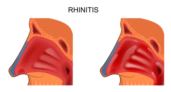 Inflammation of the nasal mucosa. rhinitis — Stock Illustration Inflammation of the nasal mucosa. rhinitis Vector Graphics