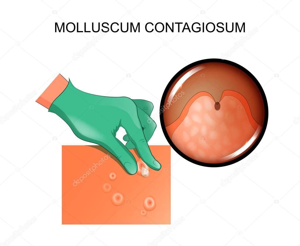 molluscum contagiosum. infection