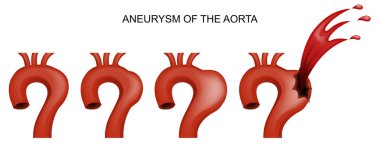 aneurysm of the aorta. cardiology clipart