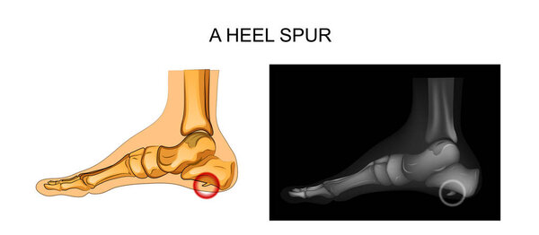 calcaneal spur. orthopedics
