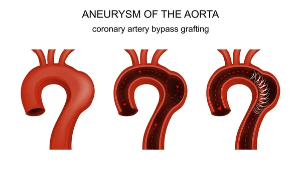 Injerto de bypass de arteria coronaria — Vector de stock