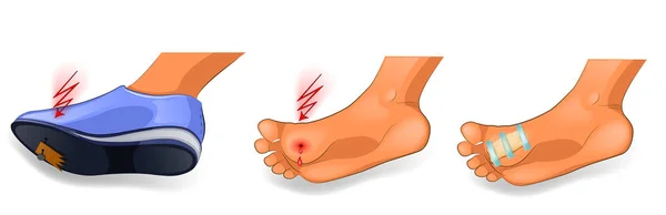 Травма стопи. цвях у нозі — стоковий вектор