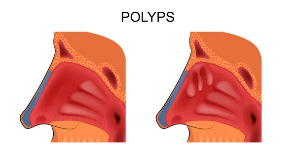 Polyper i näsan — Stock vektor