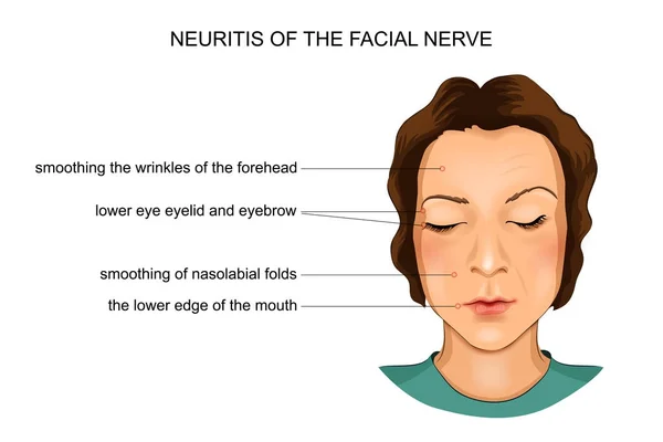 Neuritis of the facial nerve — Stock Vector