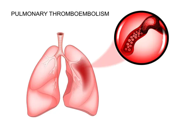 Pulmoner tromboemboli. tromboz — Stok Vektör