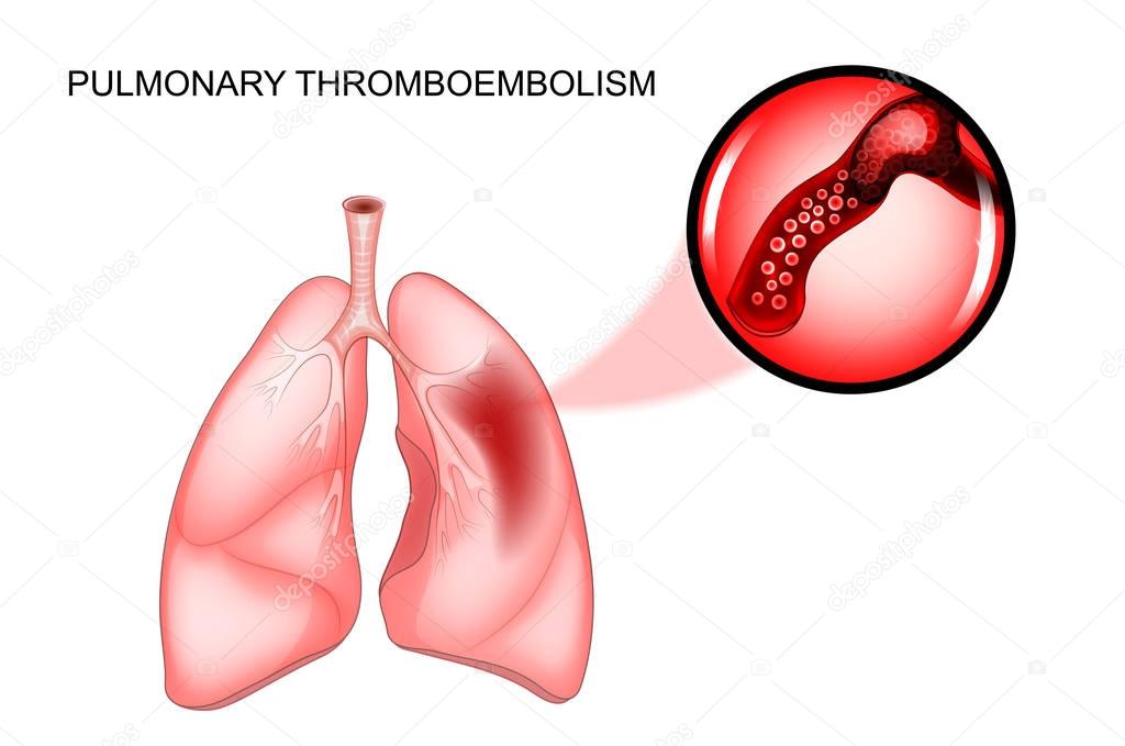 pulmonary thromboembolism. thrombosis