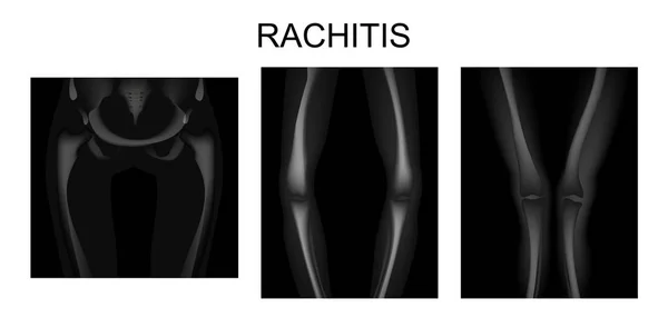 Das Skelett der unteren Extremitäten bei Rachitis — Stockvektor