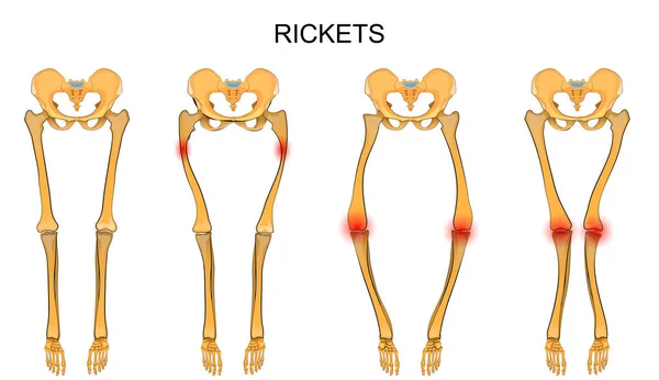Skelettet i de nedre extremiteterna i rakitis — Stock vektor
