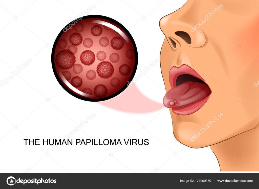 hpv virus na jazyku