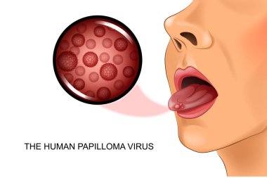dil üzerinde insan Papilloma virüsü
