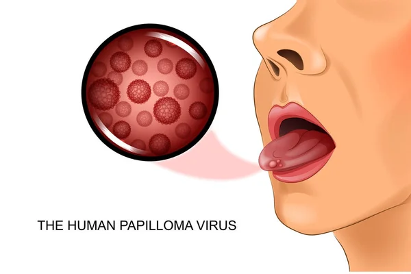 El virus del papiloma humano en la lengua — Archivo Imágenes Vectoriales