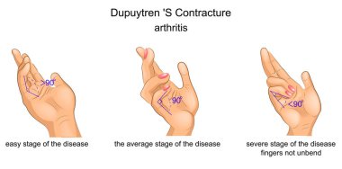 contractura aponeurosis palmaris
