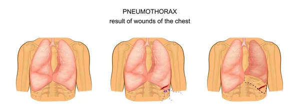 Pneumotórax como resultado de feridas no peito —  Vetores de Stock