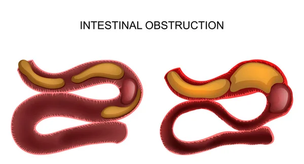 Intestinal obstruction.abdominal surgery — Stock Vector
