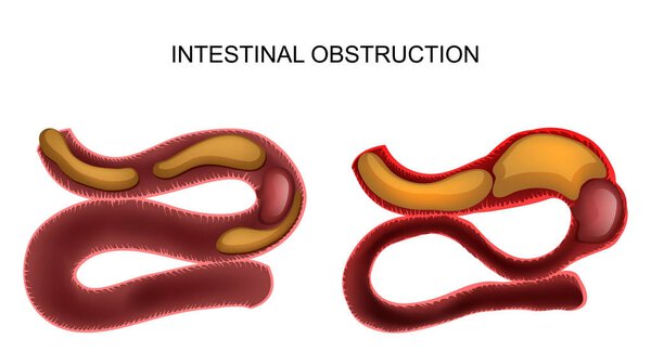 intestinal obstruction.abdominal surgery