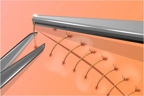 切除手术针 — 图库矢量图片