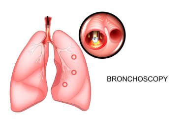 bronchoscopy of the lungs, sectional view clipart