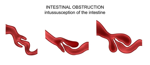 Intussusception a bél — Stock Vector