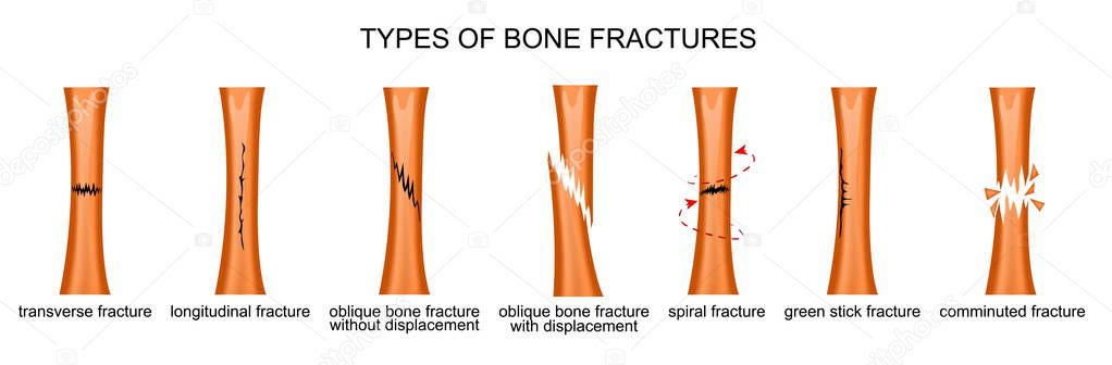 types of bone fractures