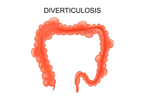 Diverticulosis van de dikke darm — Stockvector