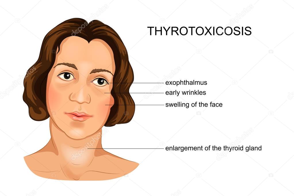 the girl's face, suffering from hypothyroidism