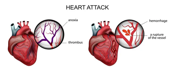 Enfarte do miocárdio. trombose e hemorragia —  Vetores de Stock