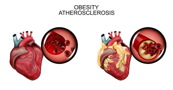 Atherosclerose schepen van het hart — Stockvector