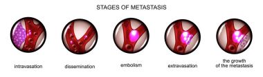 stage metastasis of cancer cells clipart
