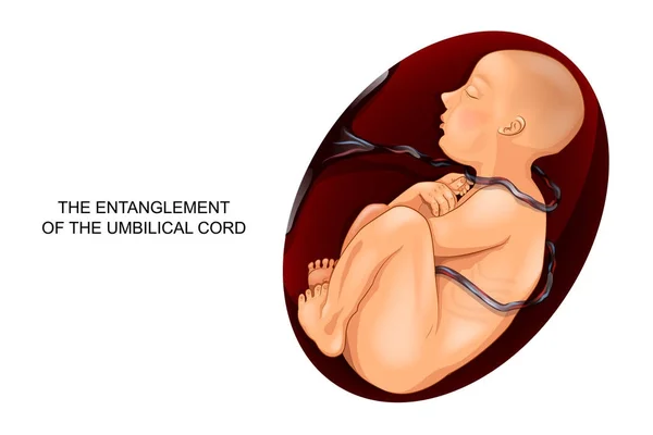 L'enchevêtrement du cordon ombilical autour du foetus — Image vectorielle