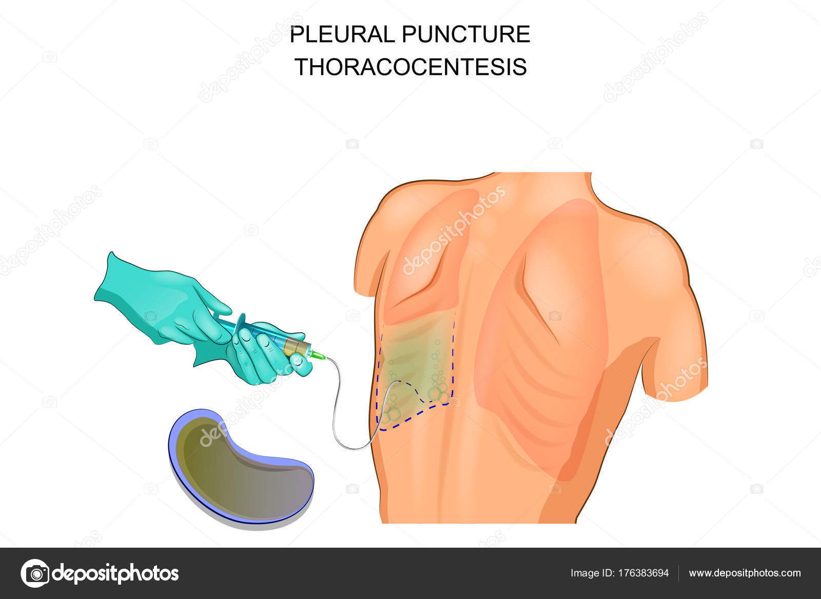 Thoracocentesis Pleural Puncture — Stock Vector © Artemida Psy 176383694