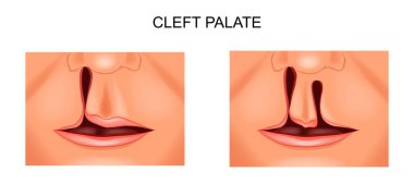 the face of a child with a defect cleft palate clipart