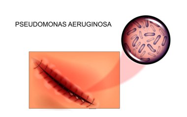 eklem iltihabı. Pseudomonas aeruginosa ile enfekte